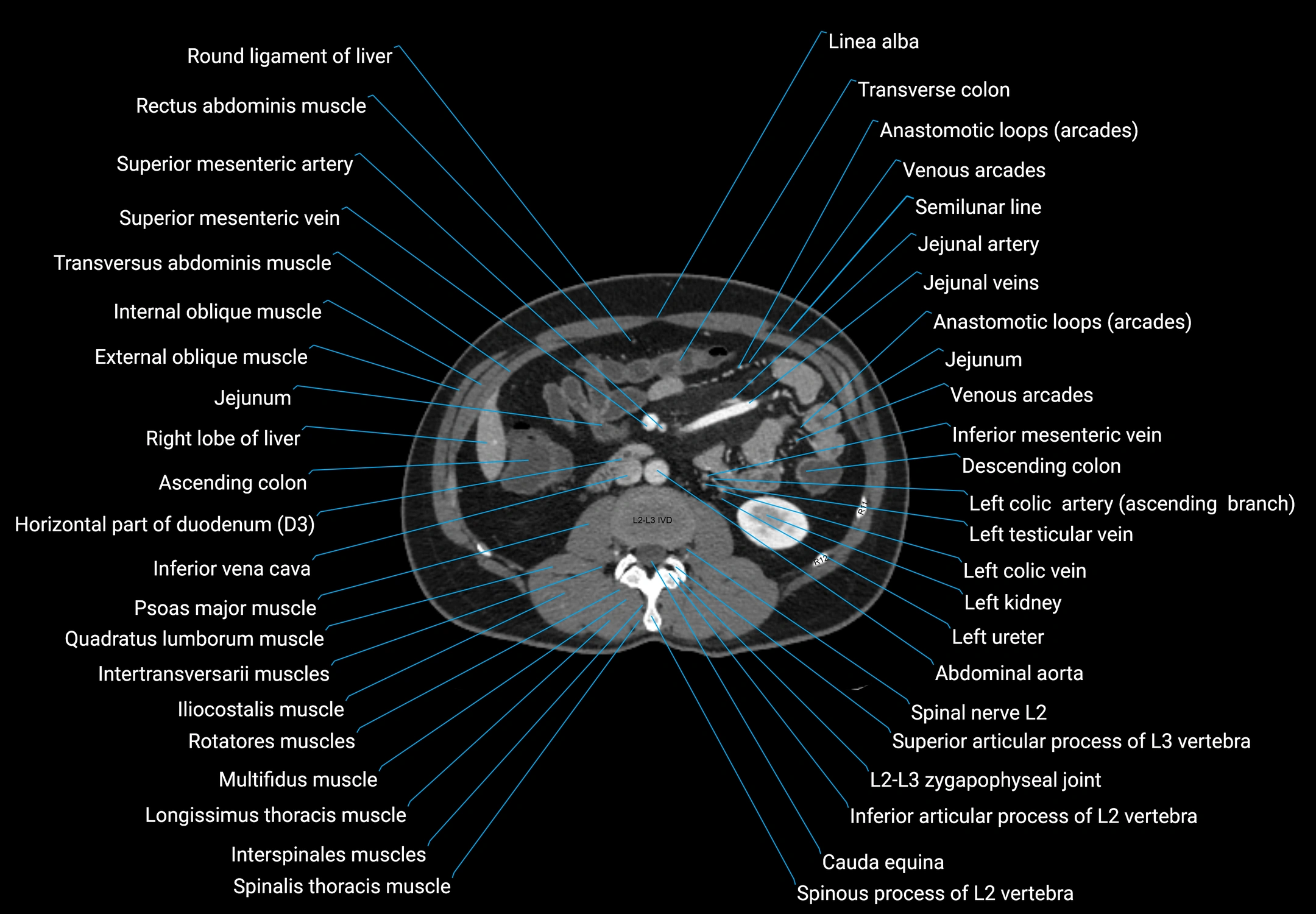 CT male pelvis axial cross sectional anatomy labelled radiology image -00083.webp